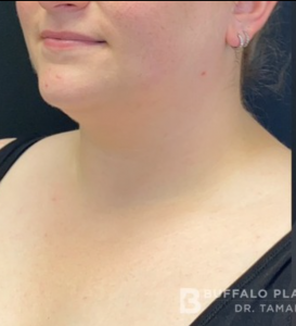 Chin Liposuction Before and After Pictures Buffalo, NY