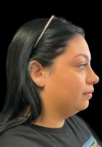 Chin Liposuction Before and After Pictures Buffalo, NY
