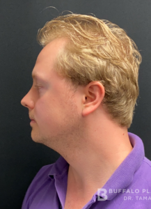 Chin Liposuction Before and After Pictures Buffalo, NY