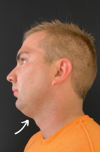 Chin Liposuction Before and After Pictures Buffalo, NY