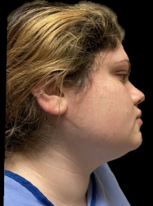 Chin Liposuction Before and After Pictures Buffalo, NY