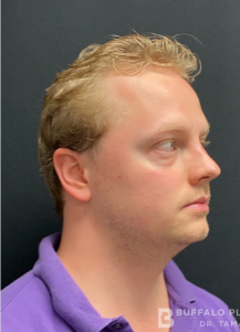 Chin Liposuction Before and After Pictures Buffalo, NY