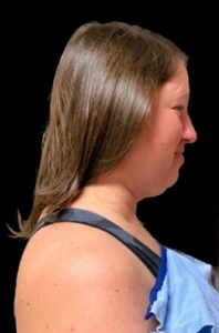 Chin Liposuction Before and After Pictures Buffalo, NY