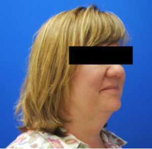 Chin Liposuction Before and After Pictures Buffalo, NY