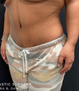 Abdominoplasty (Tummy Tuck) Before and After Pictures in Buffalo, NY