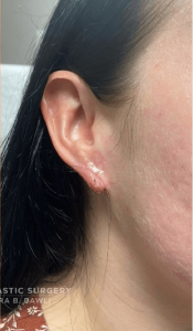 Earlobe Reconstruction Before and After Pictures Buffalo, NY