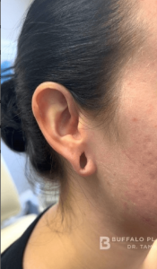 Earlobe Reconstruction Before and After Pictures Buffalo, NY