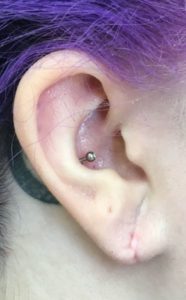 Earlobe Reconstruction Before and After Pictures Buffalo, NY