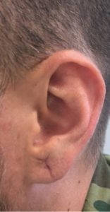 Earlobe Reconstruction Before and After Pictures Buffalo, NY