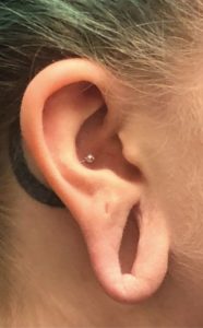 Earlobe Reconstruction Before and After Pictures Buffalo, NY