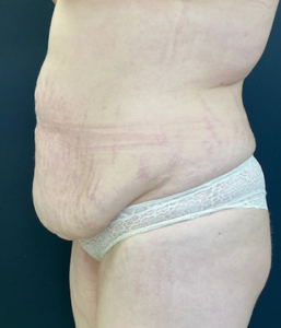 Abdominoplasty (Tummy Tuck) Before and After Pictures Buffalo, NY