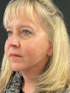 Facelift Before and After Pictures in Buffalo, NY