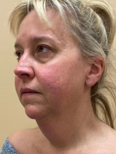 Facelift Before and After Pictures in Buffalo, NY