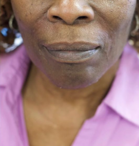 Facial Fillers Before and After Pictures in Buffalo, NY