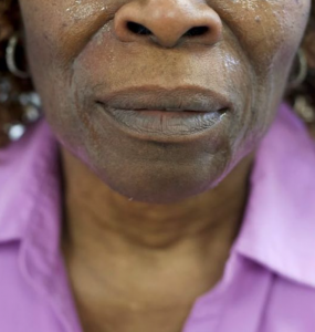 Facial Fillers Before and After Pictures in Buffalo, NY
