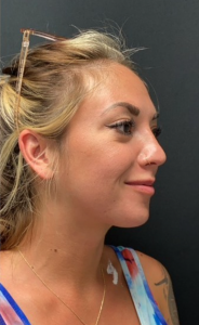 Facial Fat transfer Before and After Pictures in Buffalo, NY