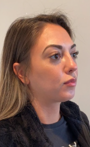Facial Fat transfer Before and After Pictures in Buffalo, NY