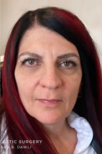 Facial Fillers Before and After Pictures in Buffalo, NY