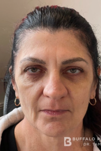 Facial Fillers Before and After Pictures in Buffalo, NY