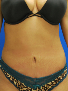 Abdominoplasty (Tummy Tuck) Before and After Pictures Buffalo, NY