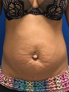 Abdominoplasty (Tummy Tuck) Before and After Pictures Buffalo, NY