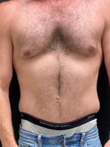 Abdominoplasty (Tummy Tuck) Before and After Pictures in Buffalo, NY