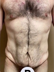 Abdominoplasty (Tummy Tuck) Before and After Pictures in Buffalo, NY