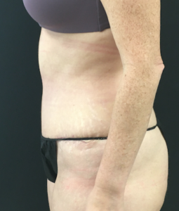 Abdominoplasty (Tummy Tuck) Before and After Pictures Buffalo, NY