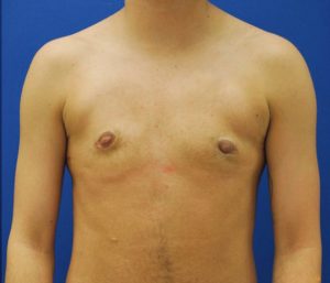 Female to Male Top Surgery Before and After Pictures in Buffalo, NY
