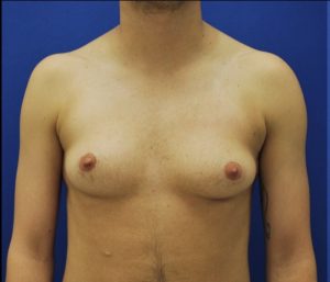 Female to Male Top Surgery Before and After Pictures in Buffalo, NY
