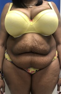 Brazilian Butt Lift Before and After Pictures Buffalo, NY
