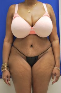 Brazilian Butt Lift Before and After Pictures Buffalo, NY