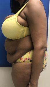 Brazilian Butt Lift Before and After Pictures Buffalo, NY
