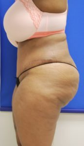 Brazilian Butt Lift Before and After Pictures Buffalo, NY