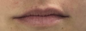Lip Augmentation Before and After Pictures Buffalo, NY