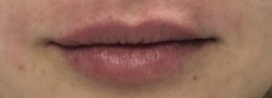 Lip Augmentation Before and After Pictures Buffalo, NY