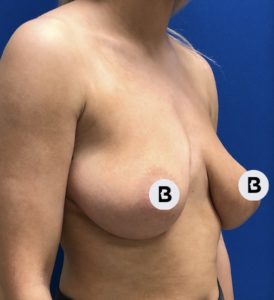Breast Augmentation Before and After Pictures Buffalo, NY