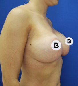 Breast Augmentation Before and After Pictures Buffalo, NY