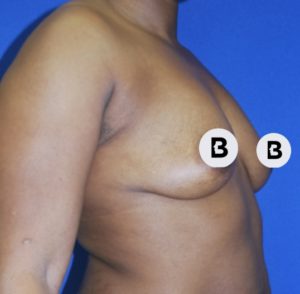 Breast Augmentation Before and After Pictures Buffalo, NY