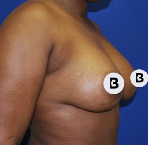 Breast Augmentation Before and After Pictures Buffalo, NY