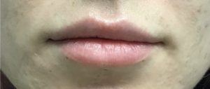Lip Augmentation Before and After Pictures Buffalo, NY