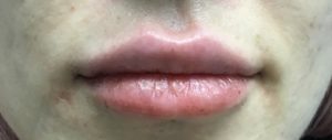 Lip Augmentation Before and After Pictures Buffalo, NY