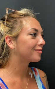 Chin Liposuction Before and After Pictures Buffalo, NY