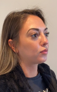 Chin Liposuction Before and After Pictures Buffalo, NY