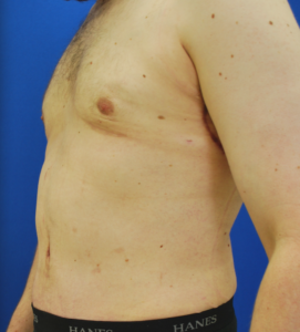 Gynecomastia (Male Chest Surgery) Before and After Pictures Buffalo, NY