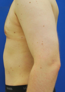 Gynecomastia (Male Chest Surgery) Before and After Pictures Buffalo, NY