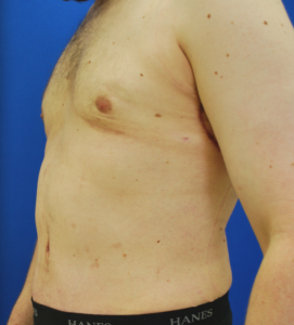 Gynecomastia (Male Chest Surgery) Before and After Pictures Buffalo, NY