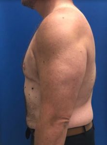 Gynecomastia (Male Chest Surgery) Before and After Pictures Buffalo, NY