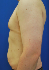 Gynecomastia (Male Chest Surgery) Before and After Pictures Buffalo, NY