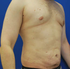 Gynecomastia (Male Chest Surgery) Before and After Pictures Buffalo, NY